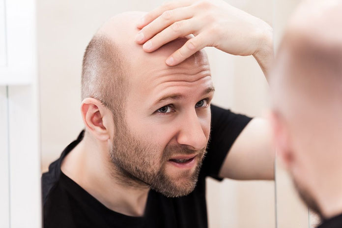 Mężczyzna z problemem łysienia przed leczeniem w Klinice Genesis