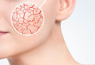 Jak sobie radzić ze skórą naczynkową?